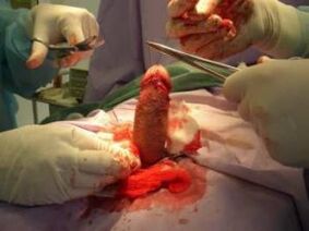kirurgji për zgjerimin e penisit